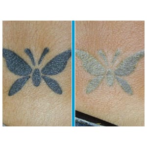 How Does Laser Tattoo Removal Work | Apps Directories